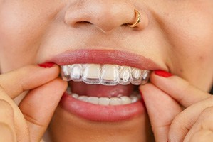 Closeup of SureSmile over woman’s upper arch