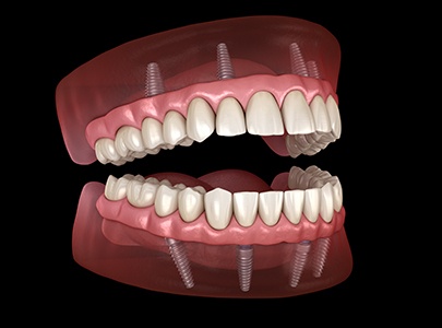 Digital illustration of all-on-4 dental implants