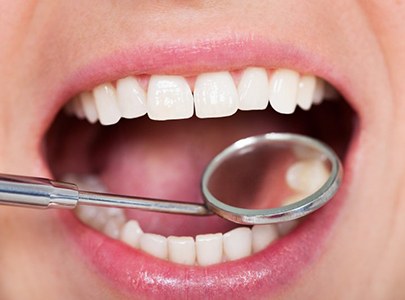 Close up of dental mirror and patient’s teeth