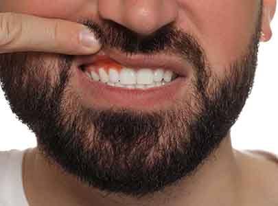 Man with red and swollen gum tissue