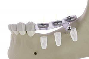 an example of the device for guided dental implant surgery