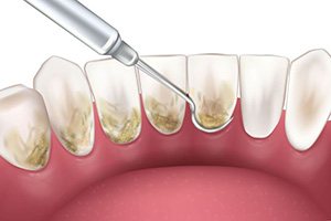 Illustration of scaler cleaning the back side of teeth